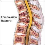 compressionfracture