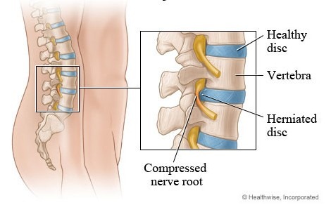 herniateddisc