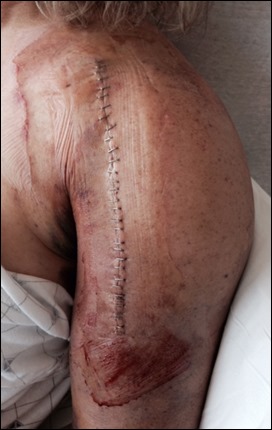 Brenda_Surgery_incision_150802